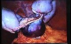 Jejunal Gastrointestinal Stromal tumor (GIST) (85 of 86)