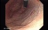 Multiple Gastric Angiodysplasia (3 of 17)