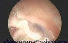 Atelectatic Tympanic Membrane