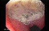 Duodenal Ulcer (1 of 4)