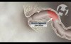 Colonoscopy
