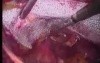 Total Extra Peritoneal (TEP) in 10 steps - Part 5