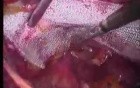 Total Extra Peritoneal (TEP) in 10 steps - Part 5