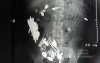 Multiple Foreign bodies in the GI tract (2 of 12)