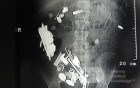 Multiple Foreign bodies in the GI tract (2 of 12)