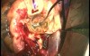 The Technique of Aortic Root Replacement