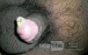 Degloving Penile Injury
