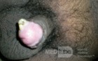Degloving Penile Injury