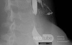 Colonic interposition for Esophageal Substitution (13 of 14)