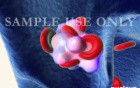 Deep Venous Thrombosis (DVT) And Pulmonary Embolism (PE)