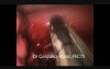 Uniportal VATS Superior Segmentectomy Carcinoid Tumor