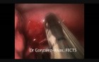 Uniportal VATS Superior Segmentectomy Carcinoid Tumor