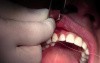 Threading - Gingival Grafting #3-6 Sites