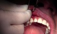 Threading - Gingival Grafting #3-6 Sites