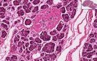 Pancreas- Hyalinized Islets