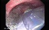 Esophagus - Pneumatic Dilation for Achalasia - Insertion of the Dilator