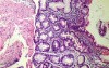 Intestinal Metaplasia (4 of 5)