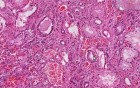 Arteriolosclerosis (Hypertension) And Hydropic Change (Cellular Swelling)
