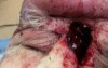 Subgaleal Abscess