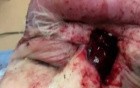 Subgaleal Abscess