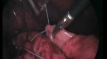Nissen Fundoplication