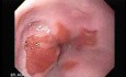 Barrett Esophagus - Endoscopic Far-Away View
