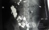 Multiple Foreign bodies in the GI tract (3 of 12)