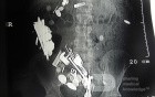 Multiple Foreign bodies in the GI tract (3 of 12)