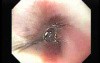 Achalasia - Presentation of Whole Esophageal Mucosa