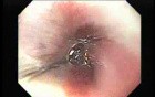 Achalasia - Presentation of Whole Esophageal Mucosa
