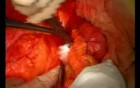 Open Right Hemicolectomy – Technical Principles - Operation No 1B - Part 2