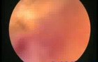 Transcervical Resction Of Fibroid