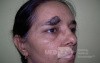 Large Black Mole- Melanoma Malignum