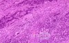Gallbladder Adenocarcinoma and litiasis (8 of 13)