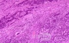 Gallbladder Adenocarcinoma and litiasis (8 of 13)