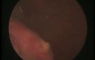 Urinary Stone