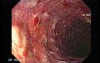 Colonic Lymphoma (5 of 6)