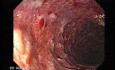 Colonic Lymphoma (5 of 6)