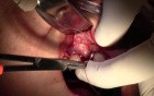 Extraction #7 with Socket Grafting - Cytoplast d-PTFE & Mineross