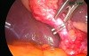 Cholecystectomy video