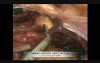 Laparoscopic Hysterectomy