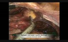 Laparoscopic Hysterectomy