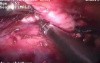 Thoracoscopic esophagectomy - 52 year old female