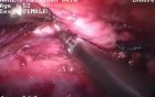 Thoracoscopic esophagectomy - 52 year old female