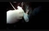 Expandable Device For Aortic Anastomosis In A Case Of ULL Cancer Infiltrating The Distal Aortic Arch