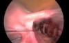 Ligation Of Uterine Artery Before Laparoscopic Myomectomy