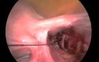 Ligation Of Uterine Artery Before Laparoscopic Myomectomy