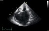 Hypertrophy of Left Antrium