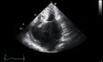 Hypertrophy of Left Antrium