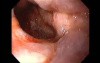 Severe Epistaxis - Case Study  (6 of 8)